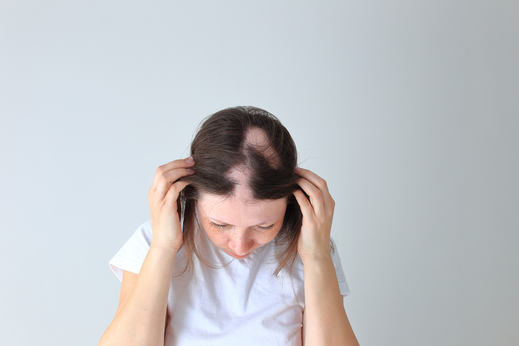 Tipos de alopecia: conhe&ccedil;a as caracter&iacute;sticas para buscar o tratamento adequado